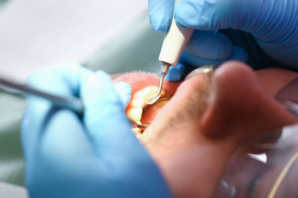 Best Emergency Tooth Extraction in Spring Hill, TN